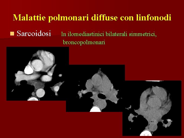 Malattie polmonari diffuse con linfonodi n Sarcoidosi ln ilomediastinici bilaterali simmetrici, broncopolmonari 