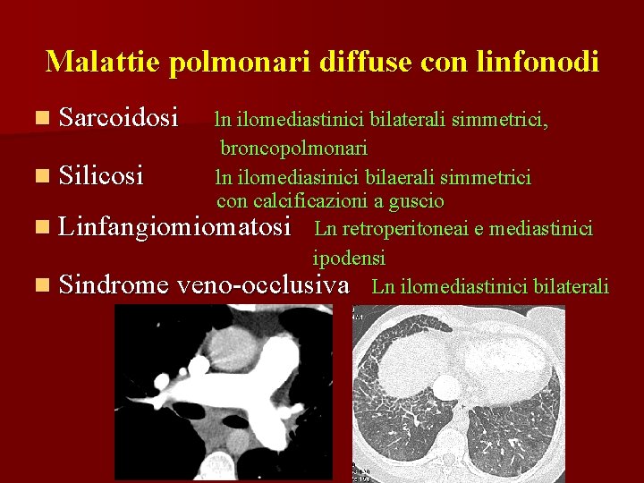 Malattie polmonari diffuse con linfonodi n Sarcoidosi ln ilomediastinici bilaterali simmetrici, broncopolmonari n Silicosi