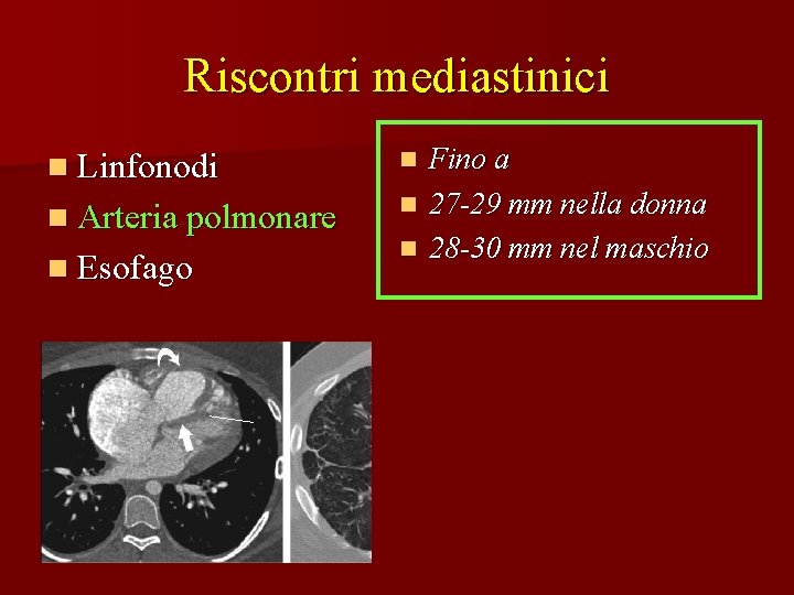 Riscontri mediastinici n Linfonodi n Arteria polmonare n Esofago Fino a n 27 -29