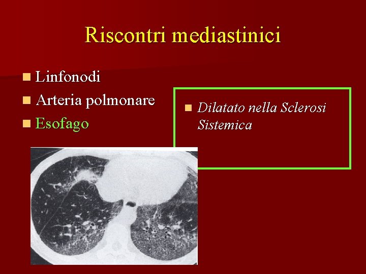 Riscontri mediastinici n Linfonodi n Arteria polmonare n Esofago n Dilatato nella Sclerosi Sistemica