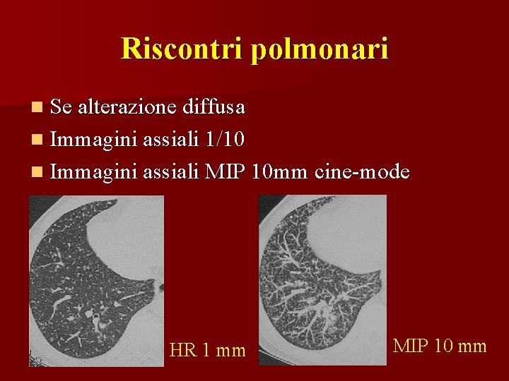 Riscontri polmonari n Se alterazione diffusa n Immagini assiali 1/10 n Immagini assiali MIP