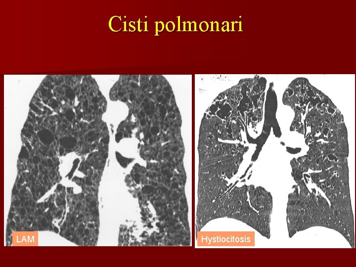 Cisti polmonari LAM Hystiocitosis 