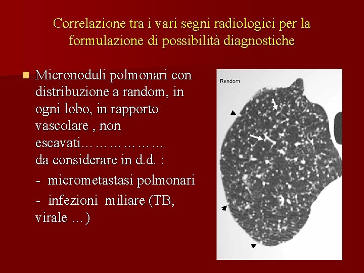 Correlazione tra i vari segni radiologici per la formulazione di possibilità diagnostiche n Micronoduli