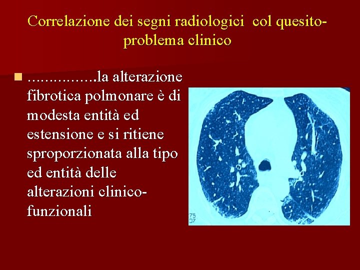 Correlazione dei segni radiologici col quesitoproblema clinico n ……………. la alterazione fibrotica polmonare è
