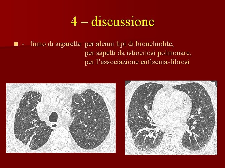 4 – discussione n - fumo di sigaretta per alcuni tipi di bronchiolite, per