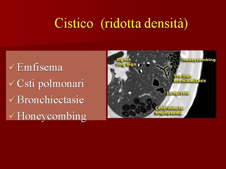 Cistico (ridotta densità) ü Emfisema ü Csti polmonari ü Bronchiectasie ü Honeycombing 