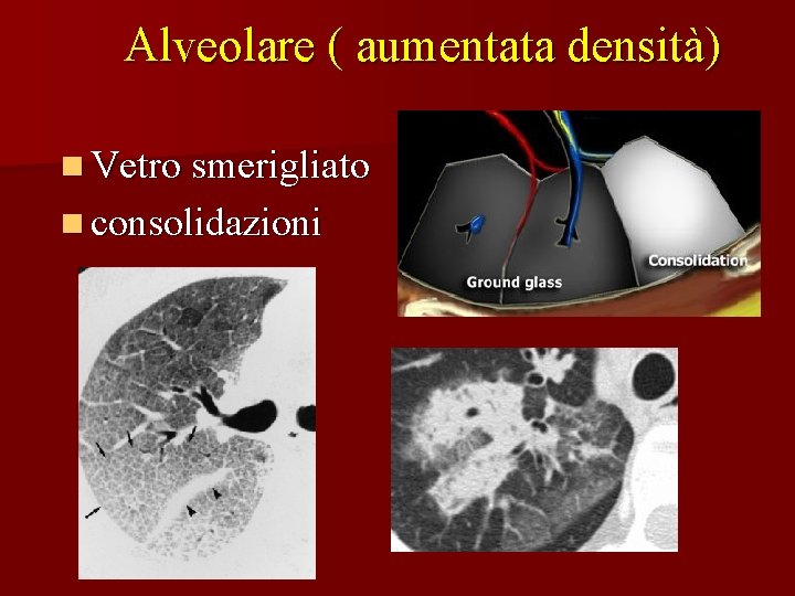 Alveolare ( aumentata densità) n Vetro smerigliato n consolidazioni 