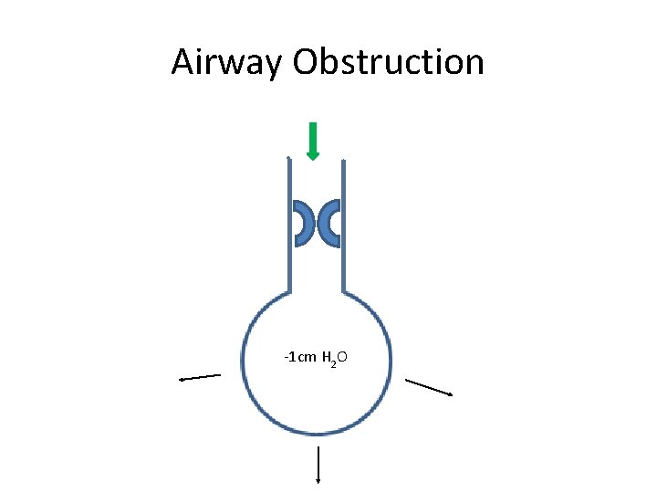 Airway Obstruction -1 cm H 2 O 
