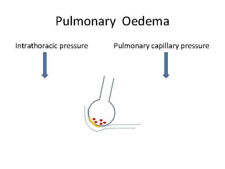 Pulmonary Oedema Intrathoracic pressure Pulmonary capillary pressure 