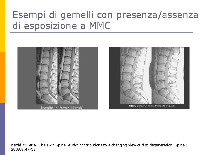 Esempi di gemelli con presenza/assenza di esposizione a MMC Battié MC et al. The