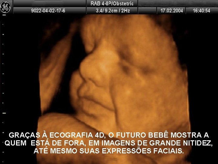 GRAÇAS À ECOGRAFIA 4 D, O FUTURO BEBÊ MOSTRA A QUEM ESTÁ DE FORA,