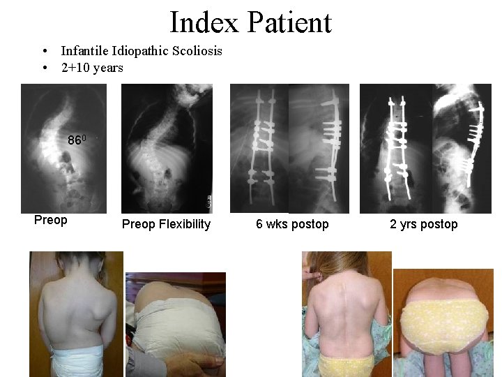 Index Patient • Infantile Idiopathic Scoliosis • 2+10 years 860 Preop Flexibility 6 wks