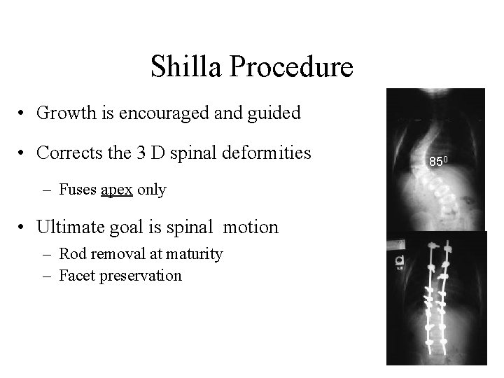 Shilla Procedure • Growth is encouraged and guided • Corrects the 3 D spinal