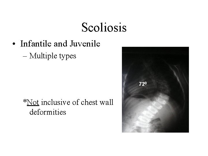 Scoliosis • Infantile and Juvenile – Multiple types 720 *Not inclusive of chest wall