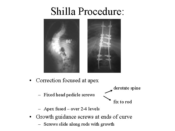 Shilla Procedure: 86º • Correction focused at apex derotate spine – Fixed head pedicle