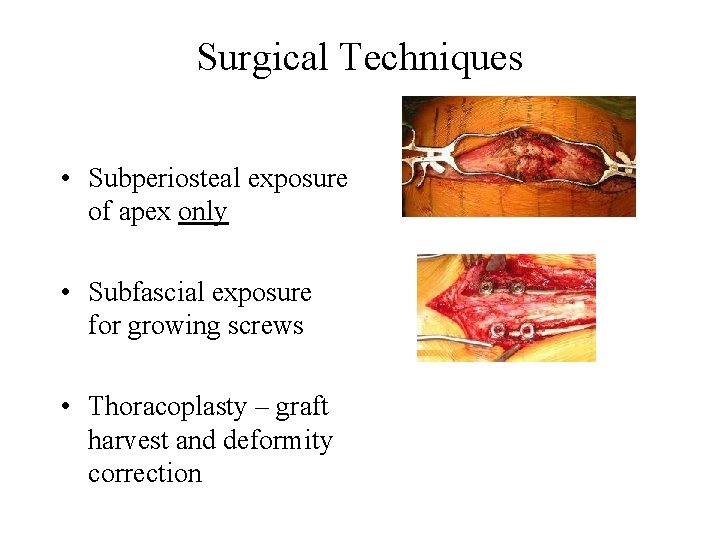 Surgical Techniques • Subperiosteal exposure of apex only • Subfascial exposure for growing screws