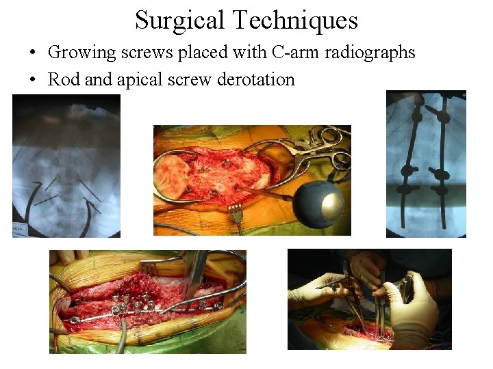 Surgical Techniques • Growing screws placed with C-arm radiographs • Rod and apical screw