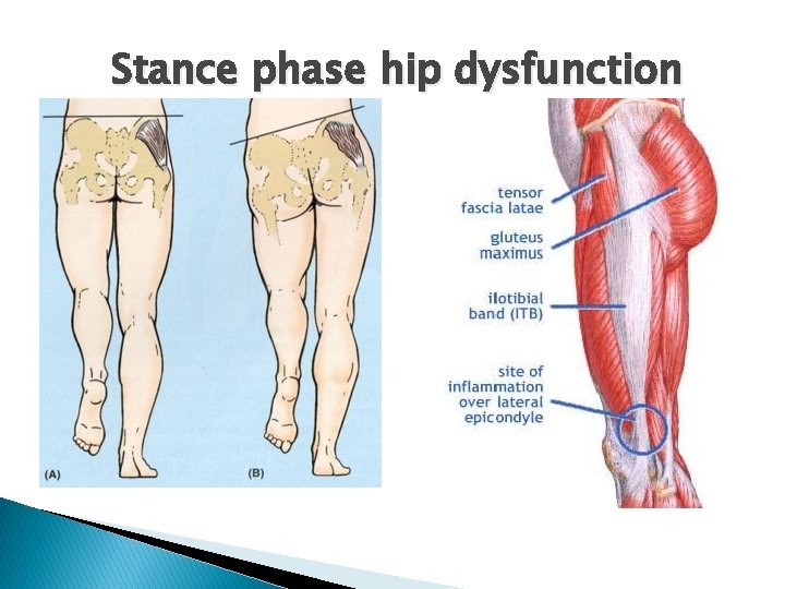 Stance phase hip dysfunction 
