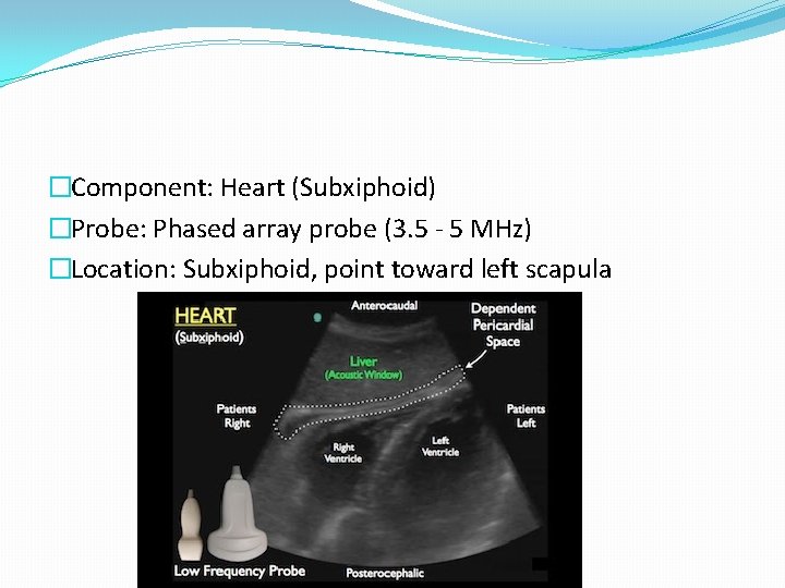 �Component: Heart (Subxiphoid) �Probe: Phased array probe (3. 5 - 5 MHz) �Location: Subxiphoid,