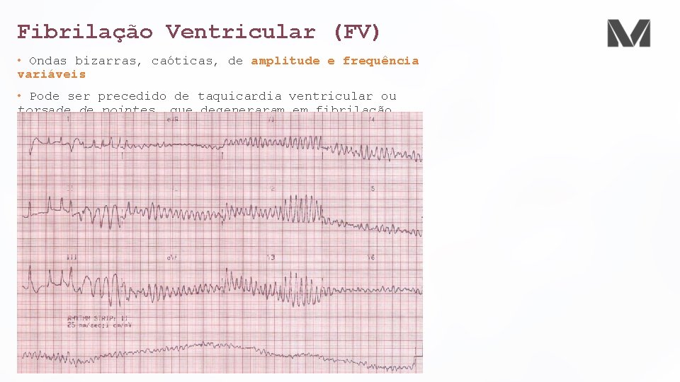 Fibrilação Ventricular (FV) • Ondas bizarras, caóticas, de amplitude e frequência variáveis • Pode