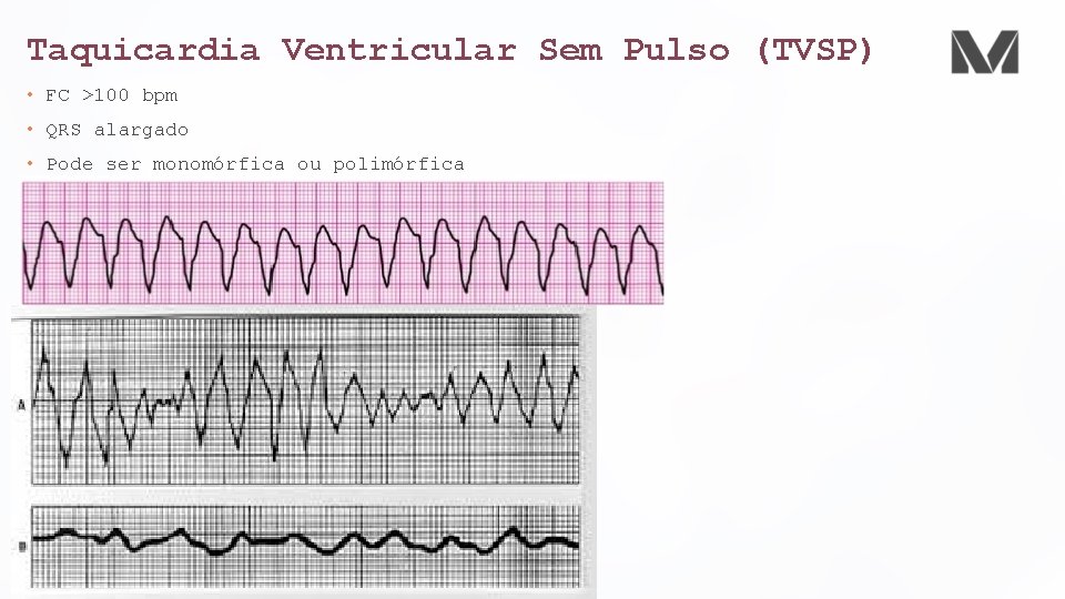 Taquicardia Ventricular Sem Pulso (TVSP) • FC >100 bpm • QRS alargado • Pode