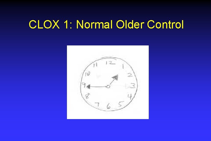 CLOX 1: Normal Older Control CLOX 1: Normal Older Control