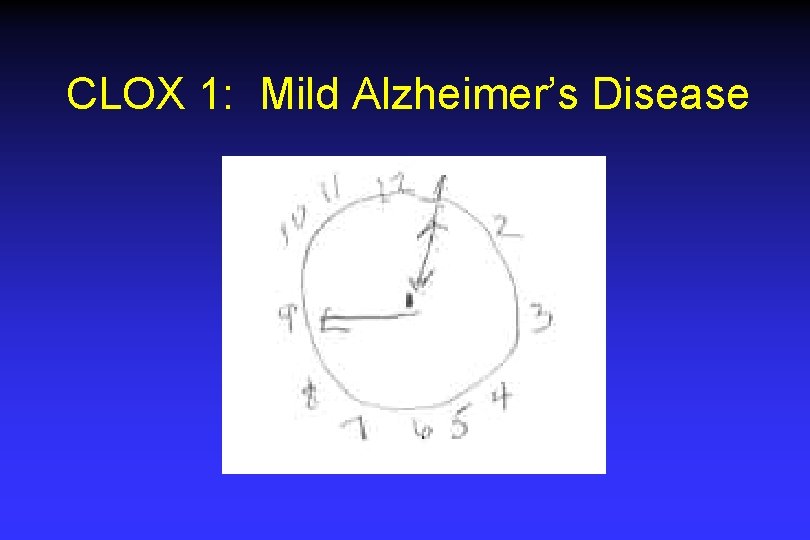 CLOX 1: Mild Alzheimer’s Disease CLOX 1: Mild Alzheimer’s Disease