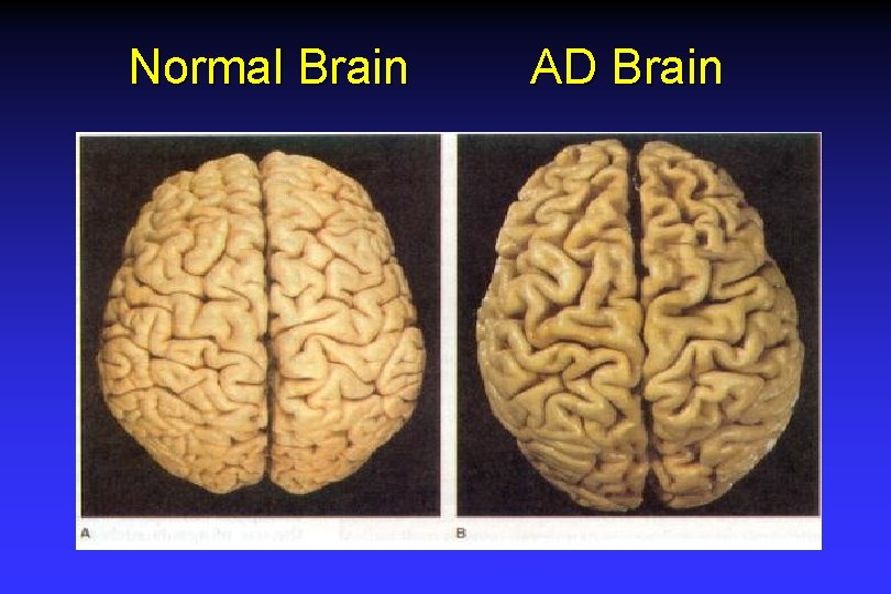 Normal Brain AD Brain Normal Brain AD Brain