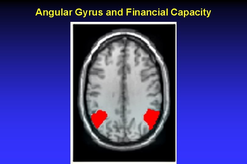 Angular Gyrus and Financial Capacity Angular Gyrus and Financial Capacity