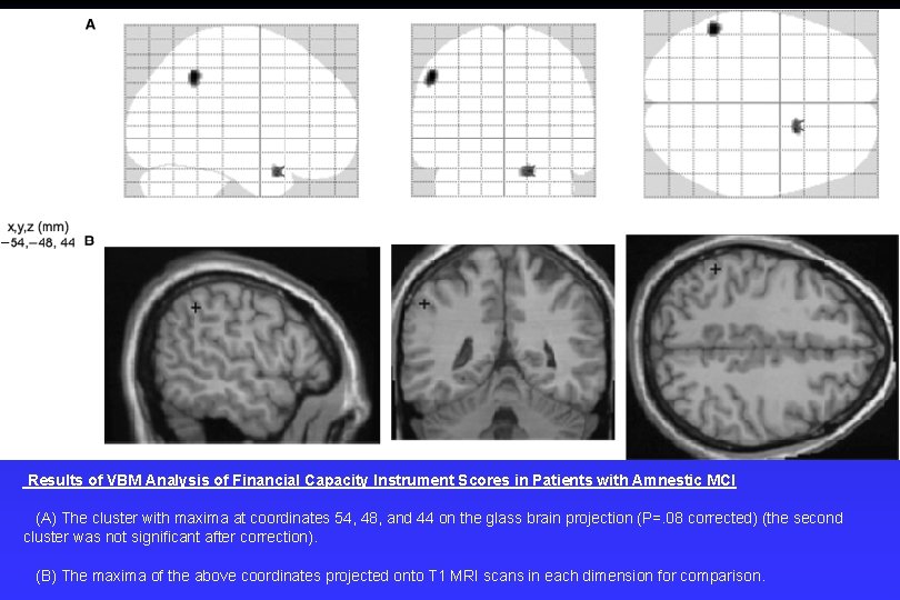 Results of VBM Analysis of Financial Capacity Instrument Scores in Patients with Amnestic MCI Results of VBM Analysis of Financial Capacity Instrument Scores in Patients with Amnestic MCI