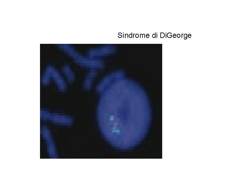 Sindrome di Di. George 