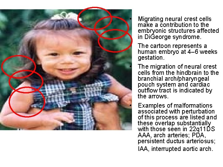  • Migrating neural crest cells make a contribution to the embryonic structures affected