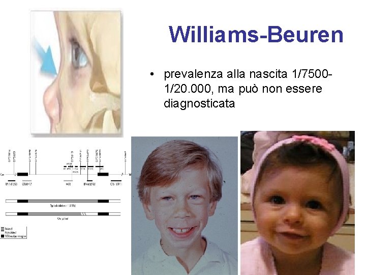 Williams-Beuren • prevalenza alla nascita 1/75001/20. 000, ma può non essere diagnosticata 