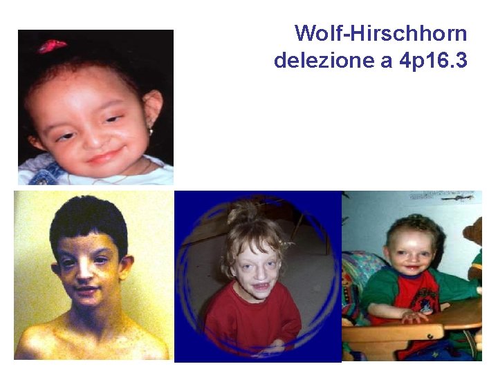 Wolf-Hirschhorn delezione a 4 p 16. 3 