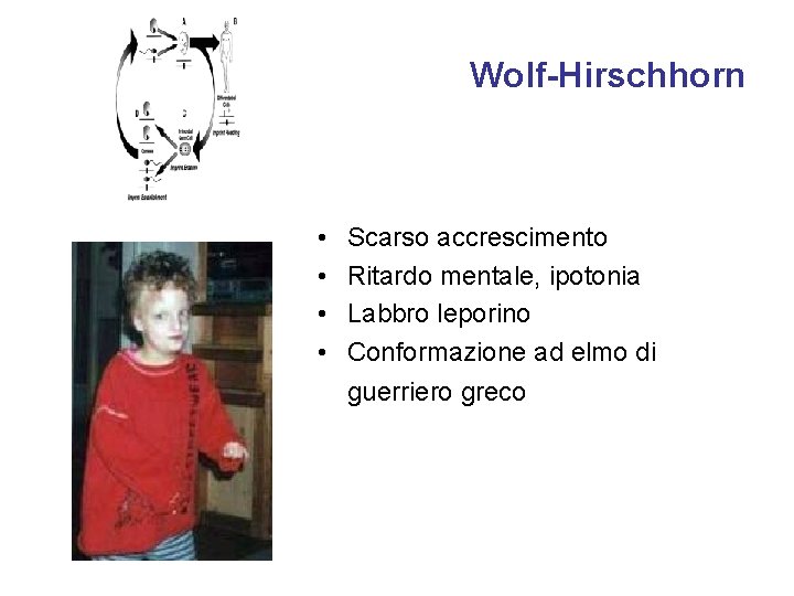 Wolf-Hirschhorn • • Scarso accrescimento Ritardo mentale, ipotonia Labbro leporino Conformazione ad elmo di