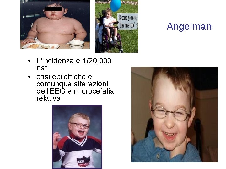 Angelman • L'incidenza è 1/20. 000 nati • crisi epilettiche e comunque alterazioni dell'EEG