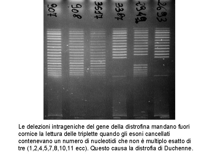 Le delezioni intrageniche del gene della distrofina mandano fuori cornice la lettura delle triplette