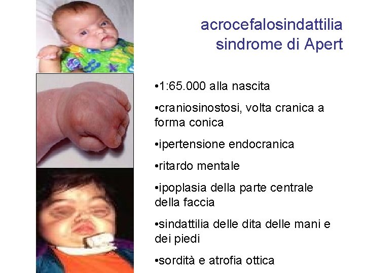 acrocefalosindattilia sindrome di Apert • 1: 65. 000 alla nascita • craniosinostosi, volta cranica