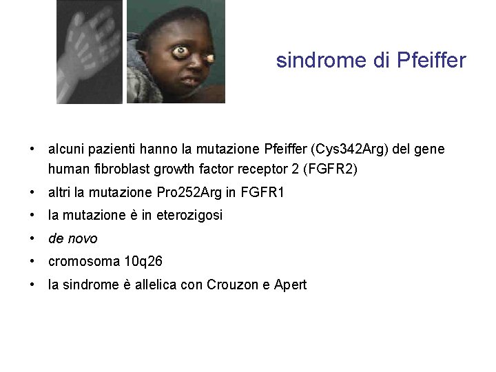 sindrome di Pfeiffer • alcuni pazienti hanno la mutazione Pfeiffer (Cys 342 Arg) del