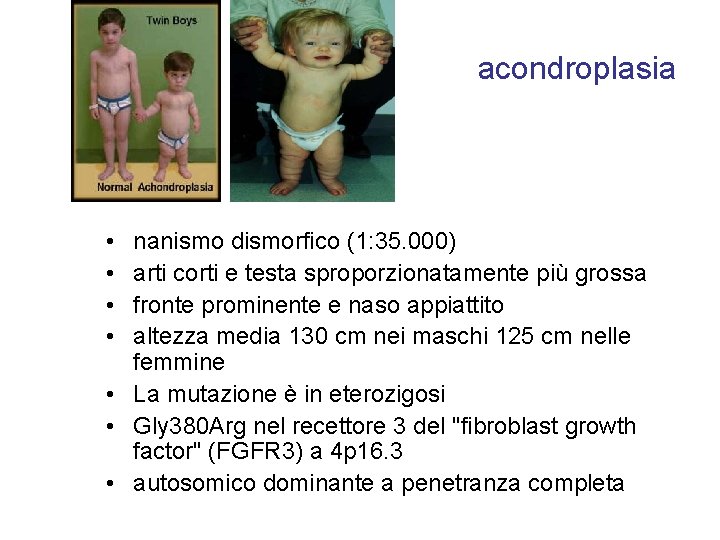 acondroplasia • • nanismo dismorfico (1: 35. 000) arti corti e testa sproporzionatamente più