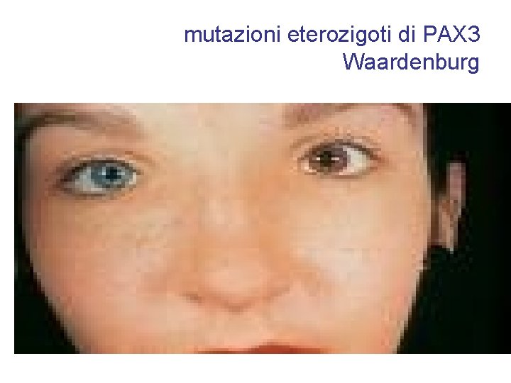 mutazioni eterozigoti di PAX 3 Waardenburg 