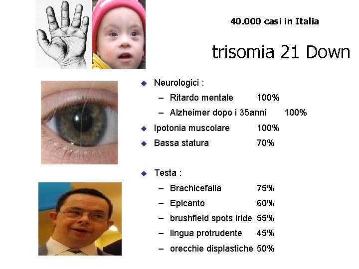 40. 000 casi in Italia trisomia 21 Down u Neurologici : – Ritardo mentale