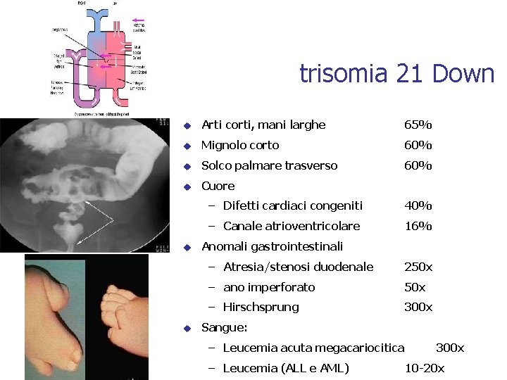 trisomia 21 Down u Arti corti, mani larghe 65% u Mignolo corto 60% u