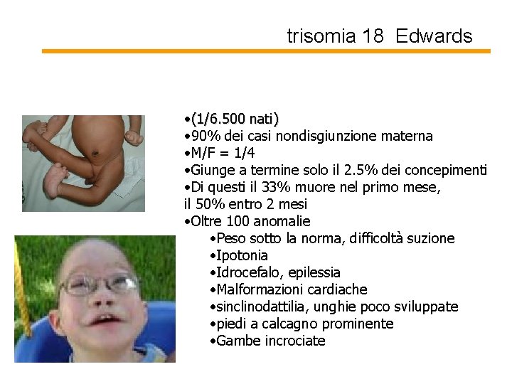 trisomia 18 Edwards • (1/6. 500 nati) • 90% dei casi nondisgiunzione materna •