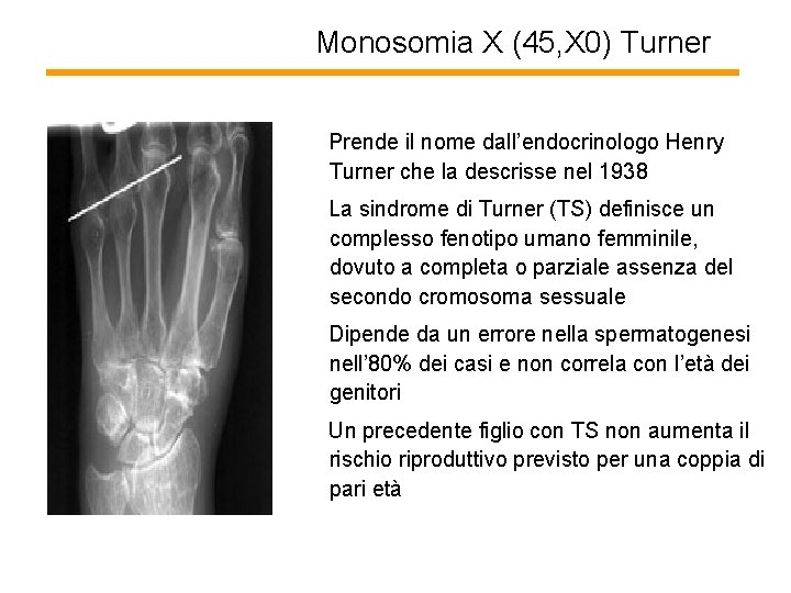 Monosomia X (45, X 0) Turner Prende il nome dall’endocrinologo Henry Turner che la