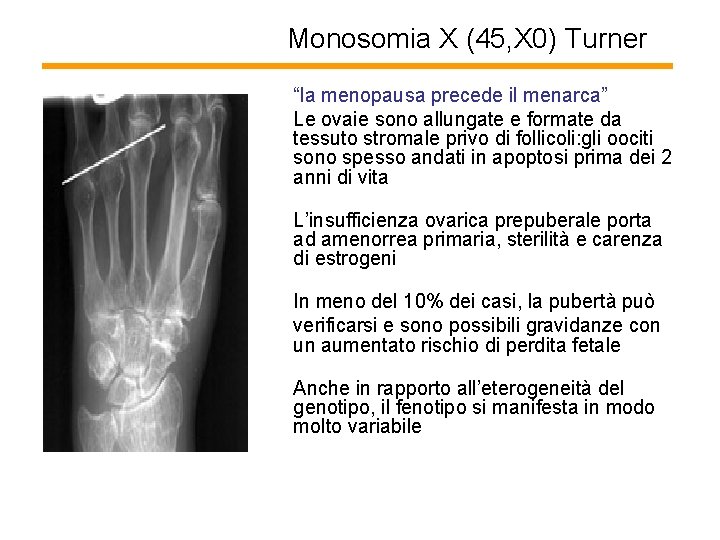 Monosomia X (45, X 0) Turner “la menopausa precede il menarca” Le ovaie sono