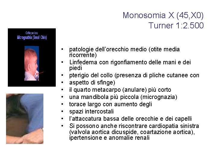 Monosomia X (45, X 0) Turner 1: 2. 500 • patologie dell’orecchio medio (otite