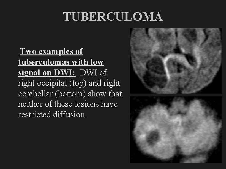 TUBERCULOMA Two examples of tuberculomas with low signal on DWI: DWI of right occipital