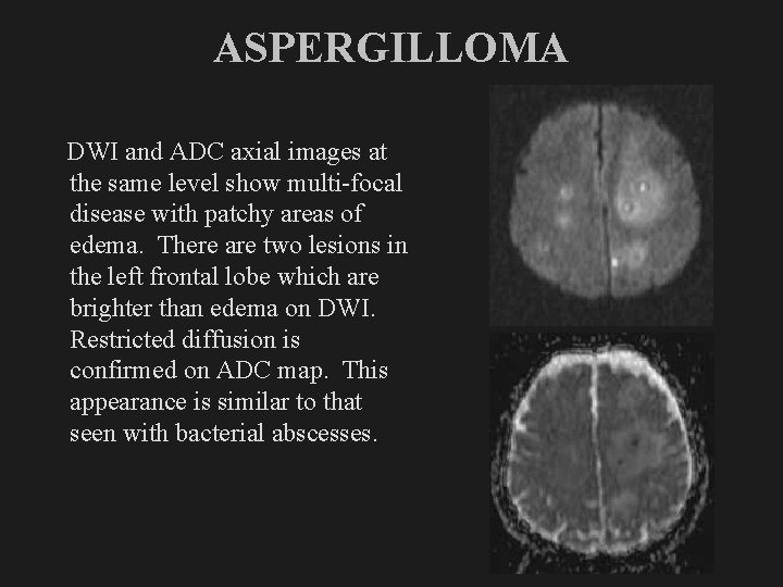 ASPERGILLOMA DWI and ADC axial images at the same level show multi-focal disease with
