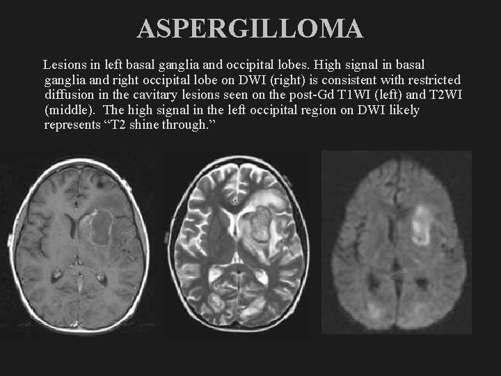 ASPERGILLOMA Lesions in left basal ganglia and occipital lobes. High signal in basal ganglia